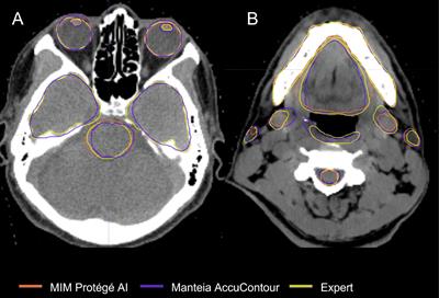 Clinical validation of commercial deep-learning based auto-segmentation models for organs at risk in the head and neck region: a single institution study